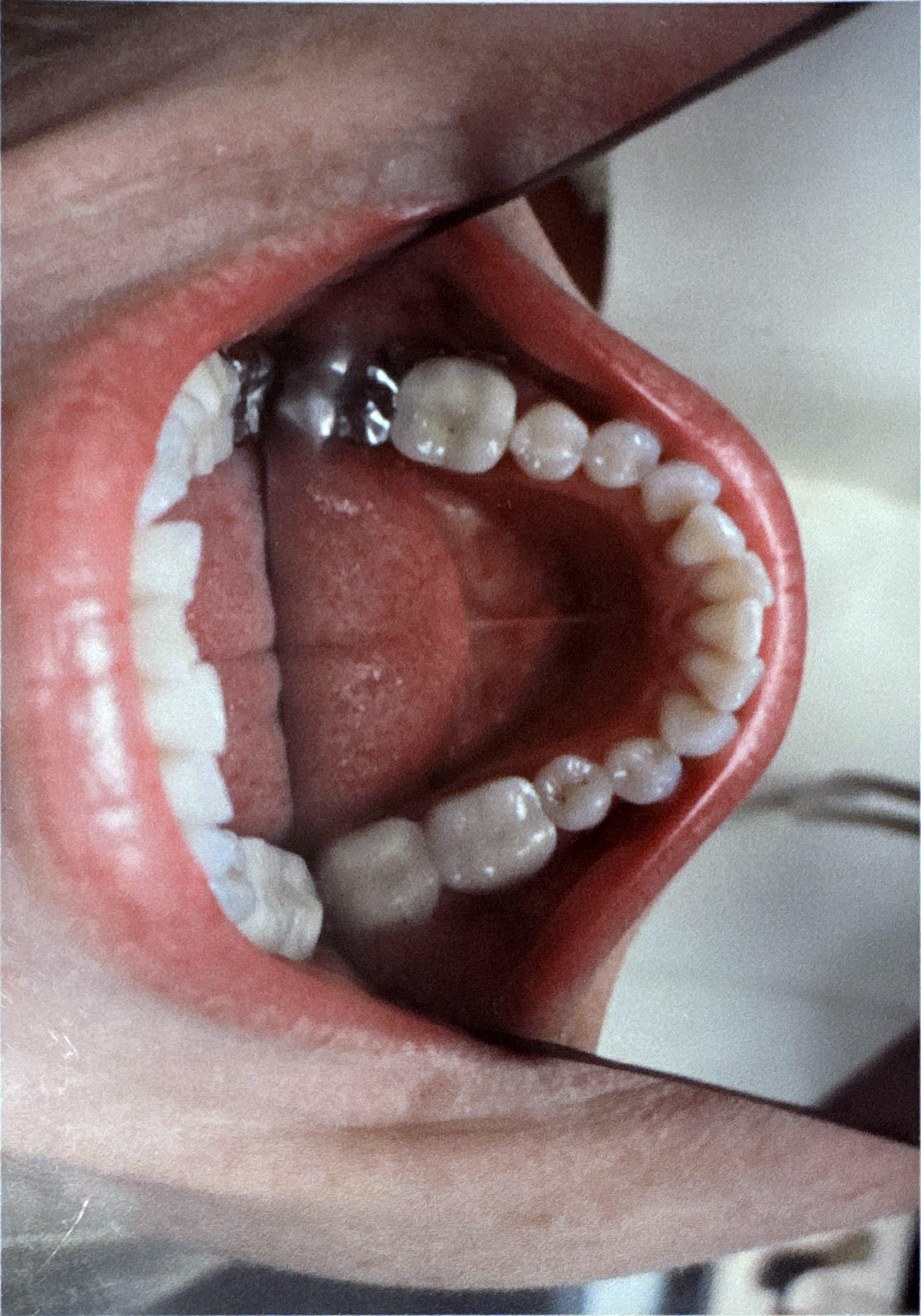 Patient teeth before Invisalign